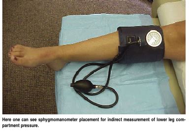 treatment for exertional compartment syndrome